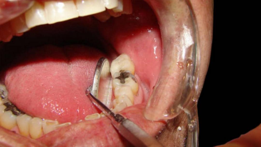 Có nhiều nguyên nhân gây đau răng bạn nên nắm rõ