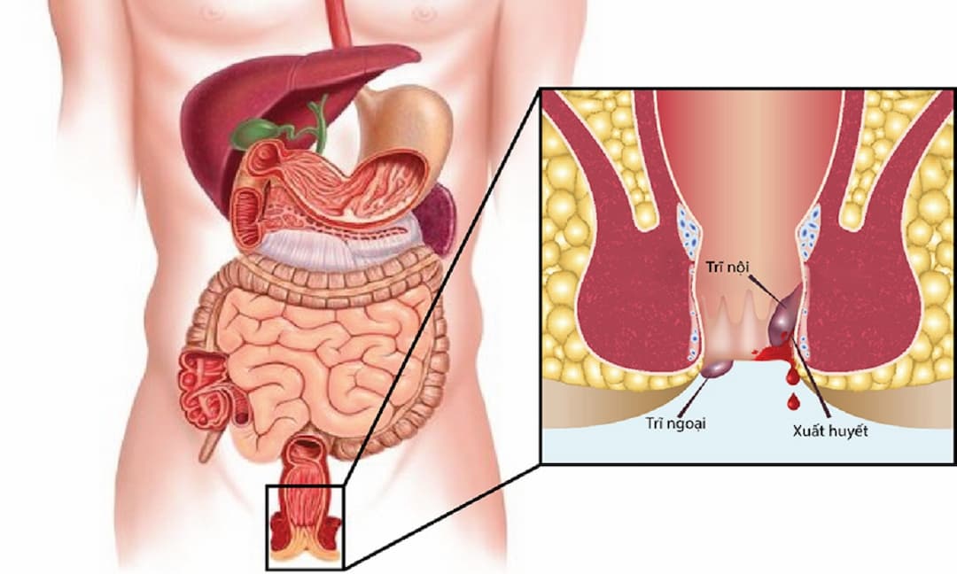 Bệnh trĩ kiêng ăn gì và những lưu ý khi mắc bệnh trĩ ?