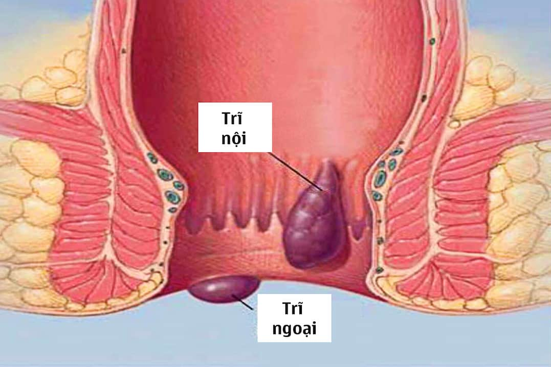 Chữa trĩ bằng nước muối có tác dụng không?