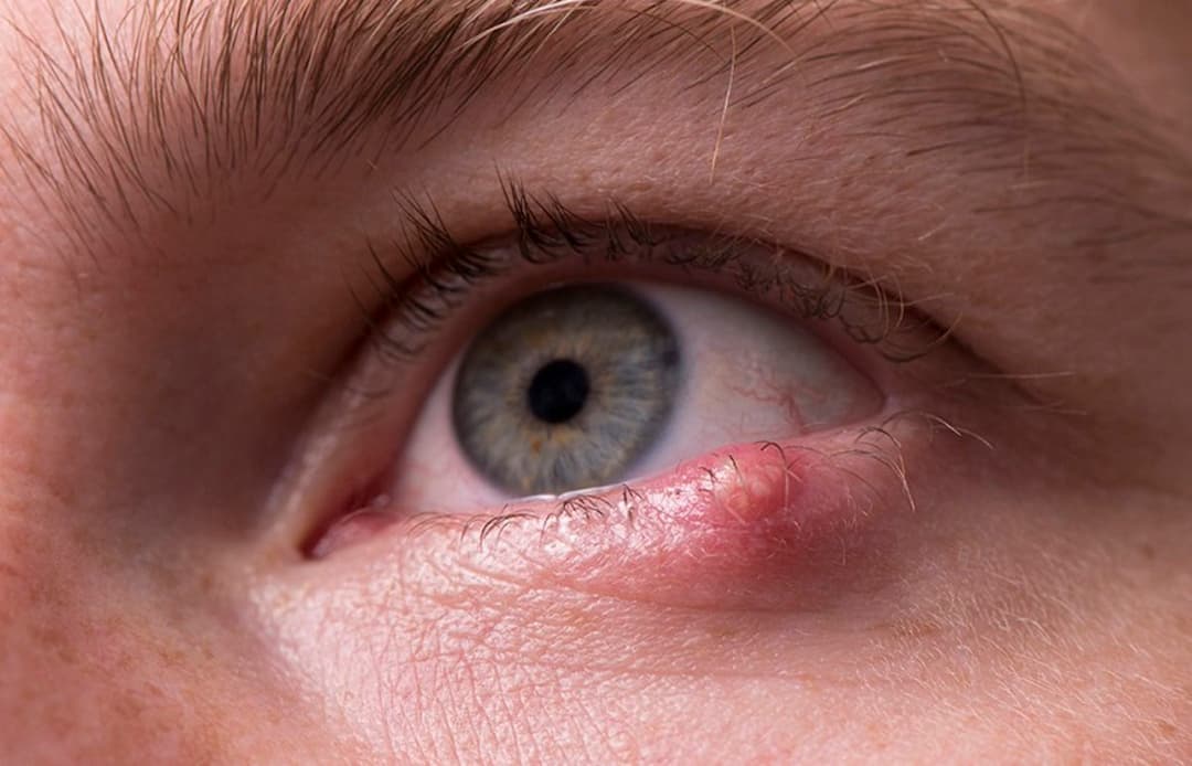 Khi bị lẹo mắt kiêng gì để bệnh nhanh khỏi?