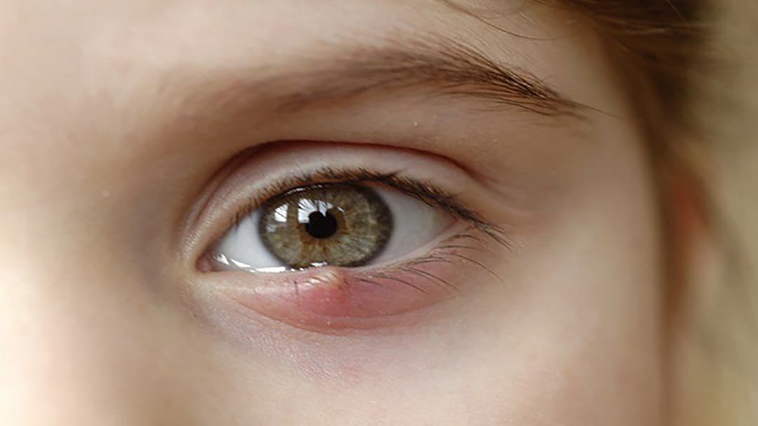 Tìm hiểu đôi nét về tình trạng lẹo mắt