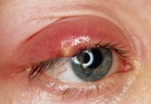 Cách chữa lẹo mắt – Phương pháp trị liệu dân gian ngày xưa Lá trầu có thể dùng để thực hiện cách chữa lẹo mắt hiệu quả