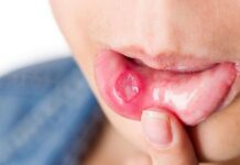 Cách chữa nhiệt miệng tại nhà đơn bạn nên tham khảo Nhiệt miệng bị phồng rộp, lở loét trong vùng miệng gây đau đớn